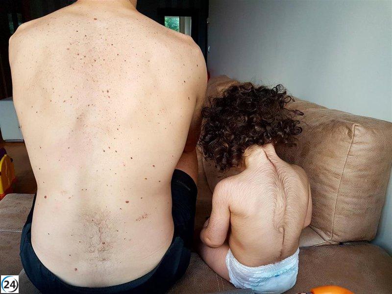 Estudio forense revela que el crecimiento de vello se mantiene en niños tratados con omeprazol