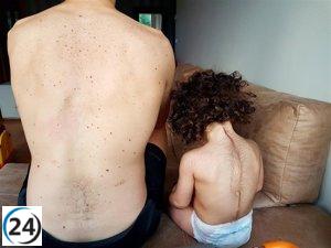 Estudio forense revela que el crecimiento de vello se mantiene en niños tratados con omeprazol